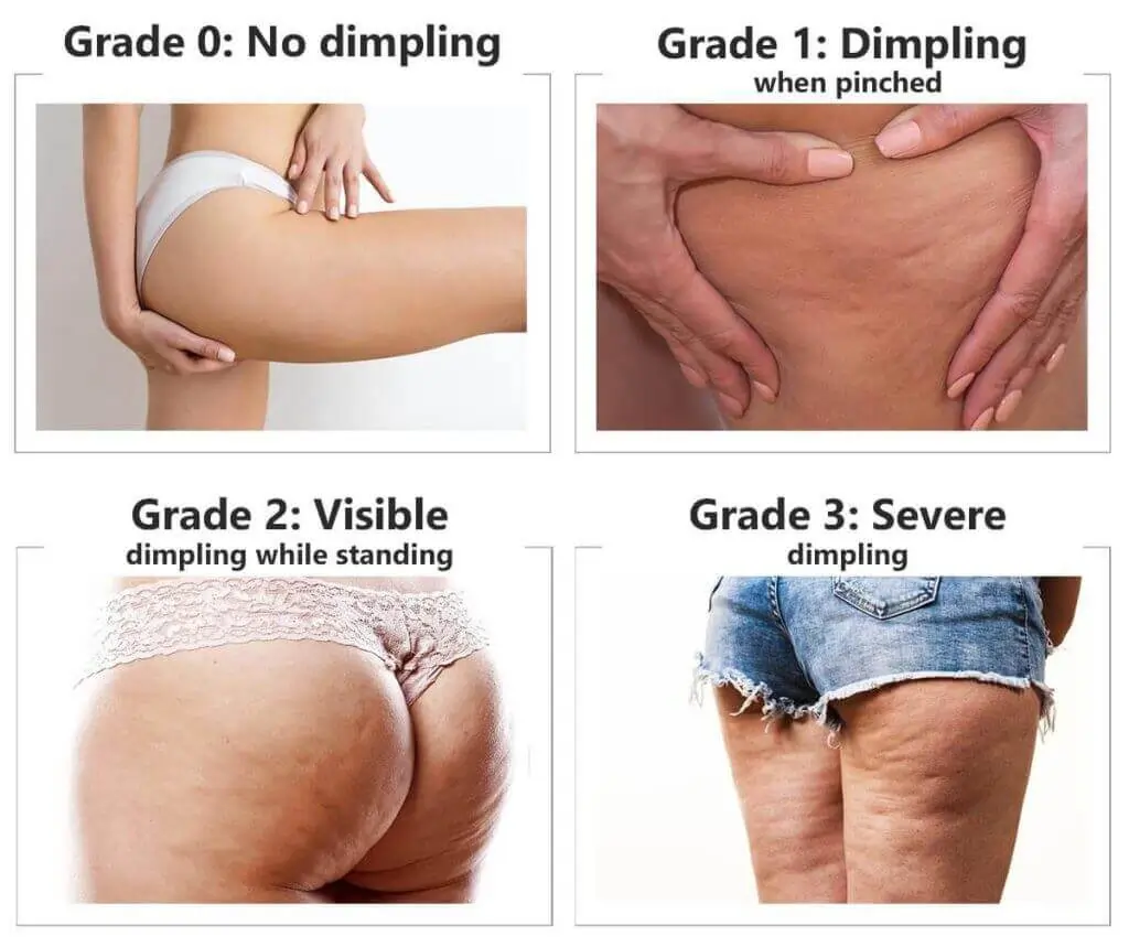 Representation of the stages of cellulite development Worthing